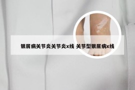 银屑病关节炎关节炎x线 关节型银屑病x线
