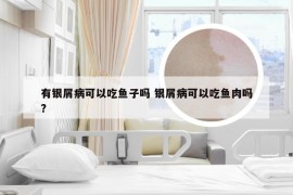 有银屑病可以吃鱼子吗 银屑病可以吃鱼肉吗?