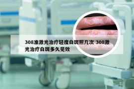 308准激光治疗轻度白斑照几次 308激光治疗白斑多久见效