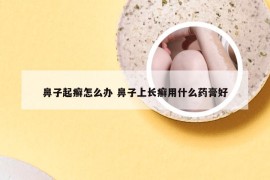鼻子起癣怎么办 鼻子上长癣用什么药膏好