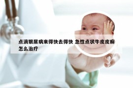 点滴银屑病来得快去得快 急性点状牛皮皮癣怎么治疗