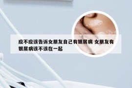 应不应该告诉女朋友自己有银屑病 女朋友有银屑病该不该在一起