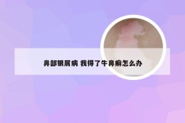 鼻部银屑病 我得了牛鼻癣怎么办