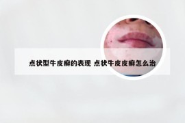 点状型牛皮癣的表现 点状牛皮皮癣怎么治