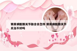 银屑病骶髂关节融合会怎样 银屑病骶髂关节炎治不好吗