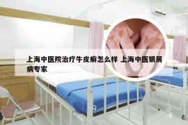 上海中医院治疗牛皮癣怎么样 上海中医银屑病专家