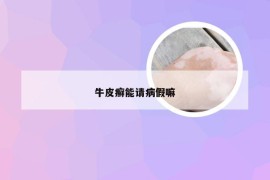 牛皮癣能请病假嘛