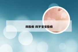 四股癣 四岁宝宝股癣