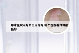 哪家医院治疗白斑治得好 哪个医院看白斑病最好