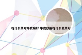 吃什么菜对牛皮癣好 牛皮肤癣吃什么蔬菜好