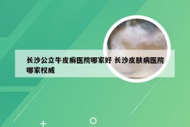 长沙公立牛皮癣医院哪家好 长沙皮肤病医院哪家权威