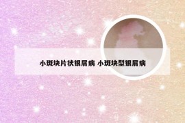 小斑块片状银屑病 小斑块型银屑病