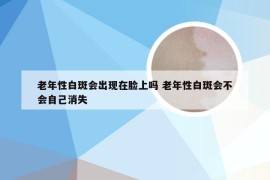 老年性白斑会出现在脸上吗 老年性白斑会不会自己消失