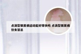 点滴型银屑病运动能好得快吗 点滴型银屑病饮食禁忌