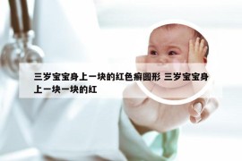 三岁宝宝身上一块的红色癣圆形 三岁宝宝身上一块一块的红
