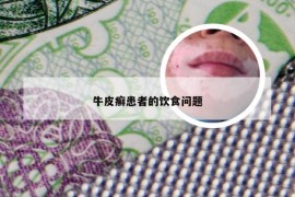 牛皮癣患者的饮食问题