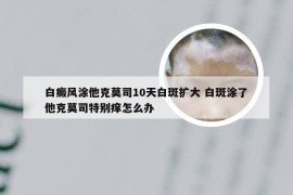 白癜风涂他克莫司10天白斑扩大 白斑涂了他克莫司特别痒怎么办