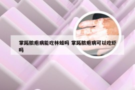 掌跖脓疱病能吃林蛙吗 掌跖脓疱病可以吃虾吗