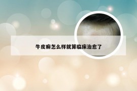 牛皮癣怎么样就算临床治愈了