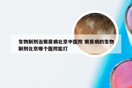 生物制剂治银屑病北京中医院 银屑病的生物制剂北京哪个医院能打