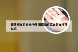 银屑病在家能光疗吗 银屑病在家自己光疗可以吗