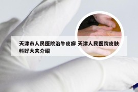 天津市人民医院治牛皮癣 天津人民医院皮肤科好大夫介绍