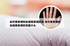 血热银屑病和血燥银屑病区别 血热银屑病和血燥银屑病区别是什么