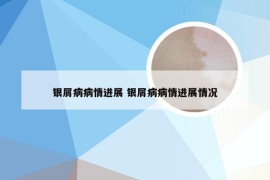 银屑病病情进展 银屑病病情进展情况