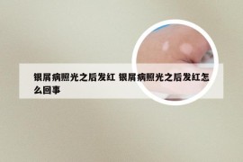 银屑病照光之后发红 银屑病照光之后发红怎么回事