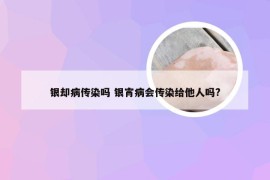 银却病传染吗 银宵病会传染给他人吗?