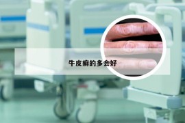 牛皮癣的多会好