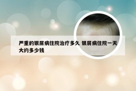 严重的银屑病住院治疗多久 银屑病住院一天大约多少钱