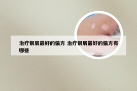 治疗银屑最好的偏方 治疗银屑最好的偏方有哪些