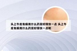 头上牛皮有癣用什么药膏好得快一点 头上牛皮有癣用什么药膏好得快一点呢