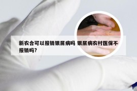 新农合可以报销银屑病吗 银屑病农村医保不报销吗?
