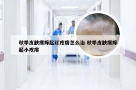 秋季皮肤瘙痒起红疙瘩怎么治 秋季皮肤瘙痒起小疙瘩