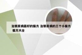 治银屑病最好的偏方 治银屑病的三个小偏方 偏方大全