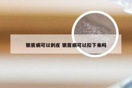 银屑病可以剥皮 银屑病可以扣下来吗