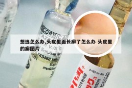 想选怎么办,头皮里面长癣了怎么办 头皮里的癣图片