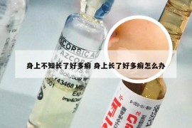 身上不知长了好多癣 身上长了好多癣怎么办