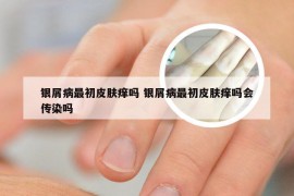 银屑病最初皮肤痒吗 银屑病最初皮肤痒吗会传染吗