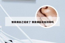 银屑病自己结皮了 银屑病起皮能扣掉吗