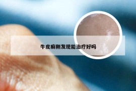牛皮癣刚发现能治疗好吗