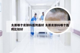 太原哪个皮肤科医院最好 太原皮肤科哪个医院比较好