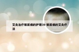 艾灸治疗银屑病的护理39 银屑病的艾灸疗法
