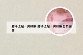 脖子上起一片红癣 脖子上起一片红癣怎么回事