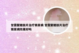 甘露聚糖肽片治疗银屑病 甘露聚糖肽片治疗银屑病效果好吗