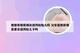 爸爸有银屑病会遗传给胎儿吗 父亲是银屑病患者会遗传给儿子吗