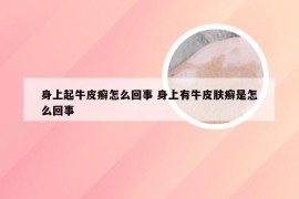 身上起牛皮癣怎么回事 身上有牛皮肤癣是怎么回事