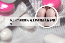 身上长了癣的照片 身上长癣是什么样子?图片